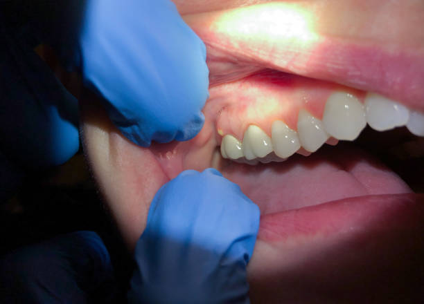 Best Chipped Tooth Repair Near Me  in Norris City, IL